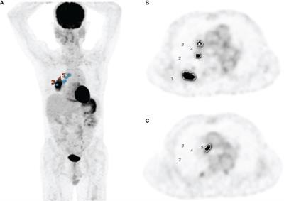 Predictive value of baseline metabolic tumor burden on 18F-FDG PET/CT for brain metastases in patients with locally advanced non-small-cell lung cancer